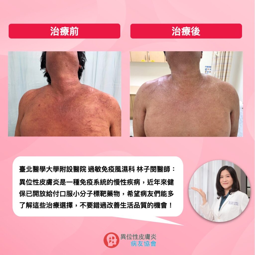 重度異膚突襲人生！健保給付口服新藥擺脫異膚難以成眠的掙扎