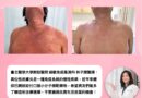 重度異膚突襲人生！健保給付口服新藥擺脫異膚難以成眠的掙扎