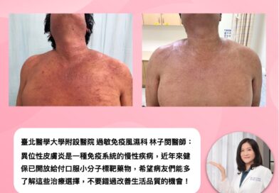 重度異膚突襲人生！健保給付口服新藥擺脫異膚難以成眠的掙扎