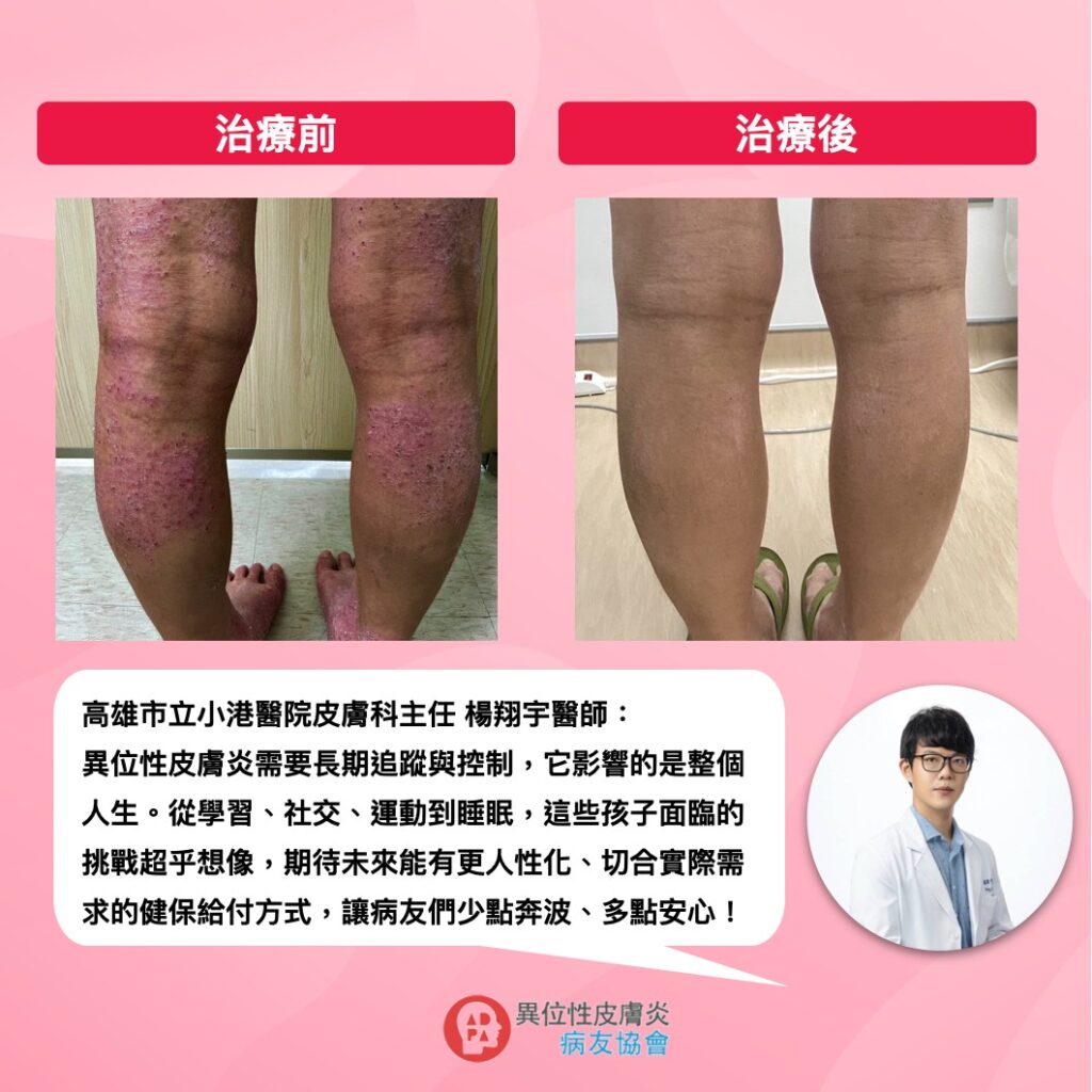 健保新藥成重度異膚治癒轉機 小學霸：「我長大要當皮膚科醫師！」